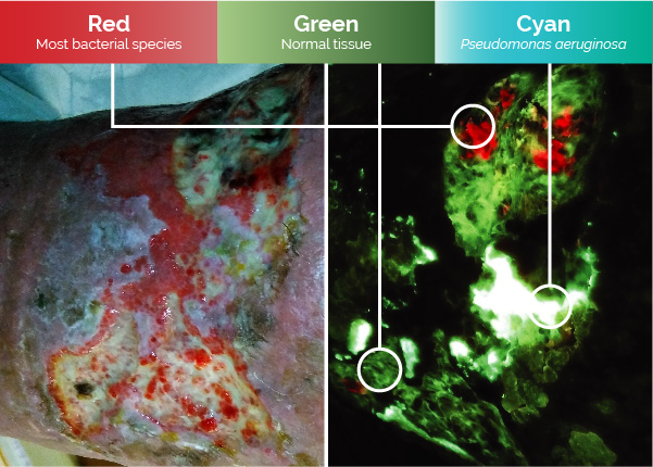 Fluorescence imaging showing bacterial detection in wounds
