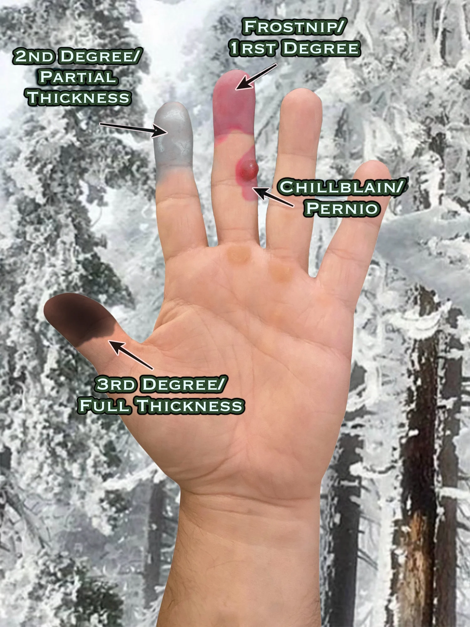 Hand illustrating the four degrees of frostbite: 1st degree (frostnip), 2nd degree (superficial), 3rd degree (deep), and 4th degree (full-thickness)