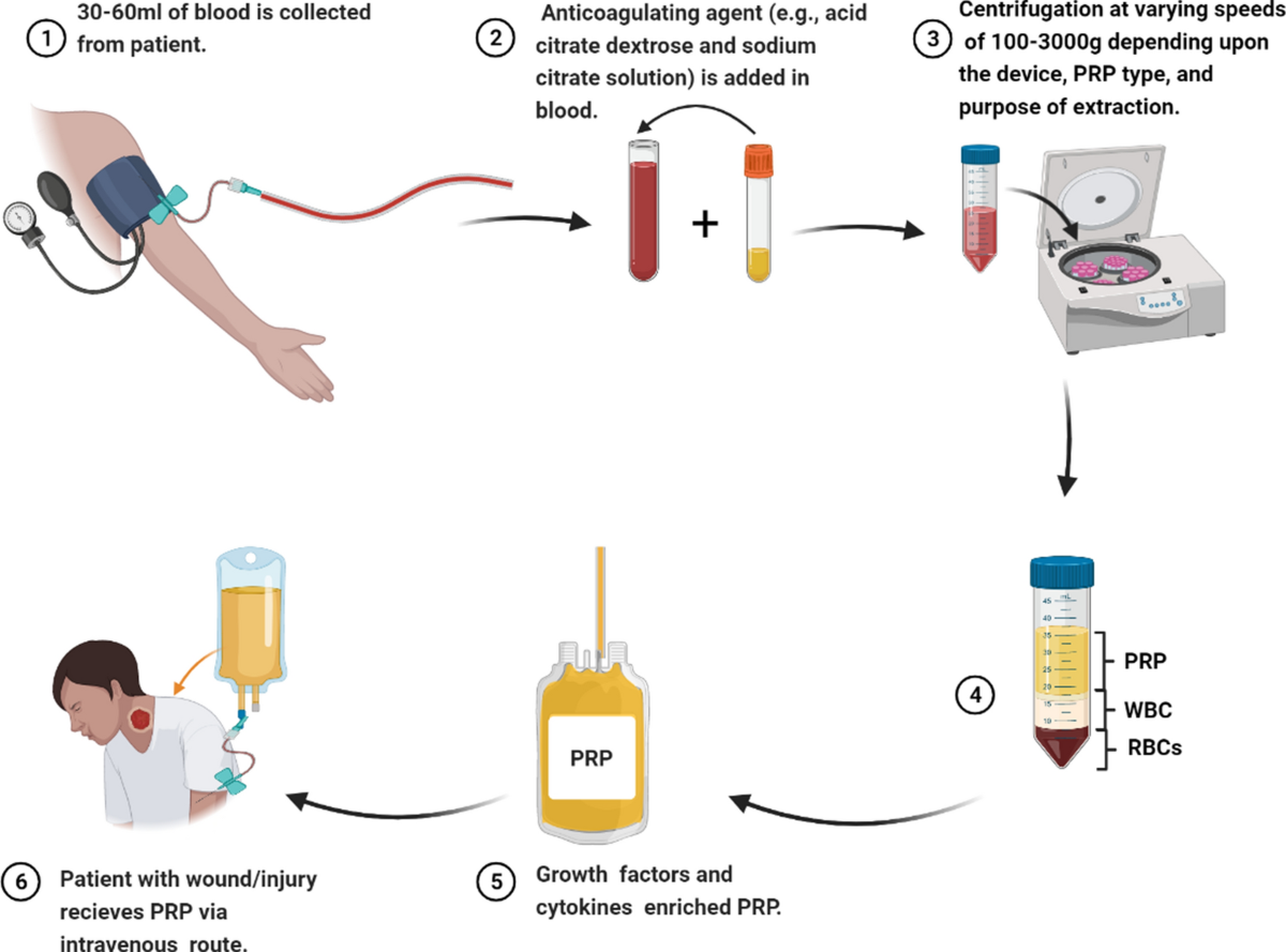 PRP preparation process: blood draw, anticoagulant addition, centrifugation, platelet separation, enrichment, and application