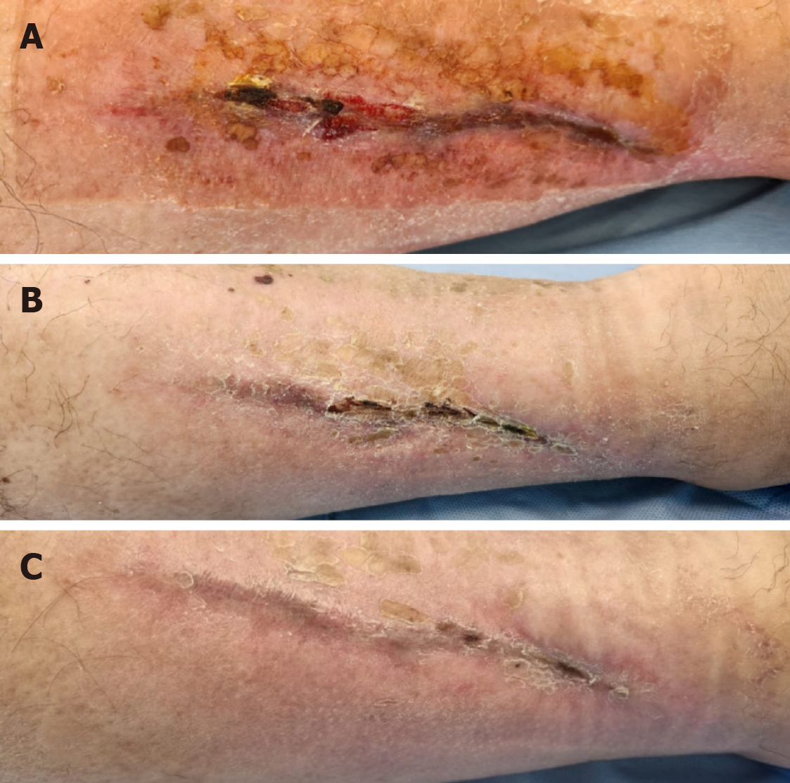 Chronic wound healing progression with PRP treatment showing improvement over time