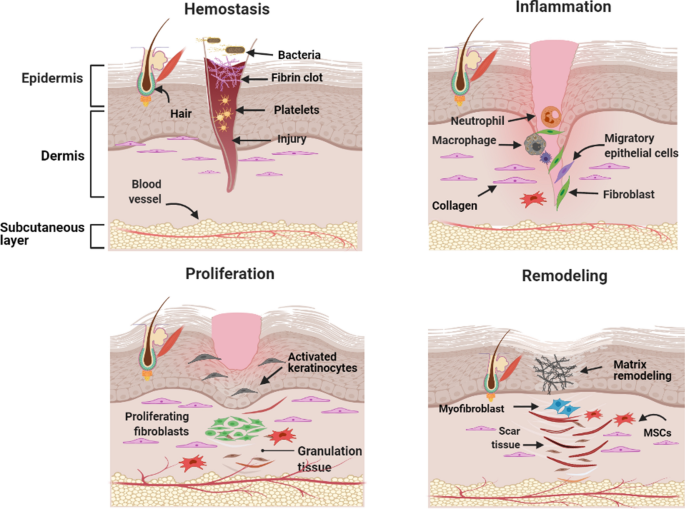 The four phases of wound healing: hemostasis, inflammation, proliferation, and remodeling